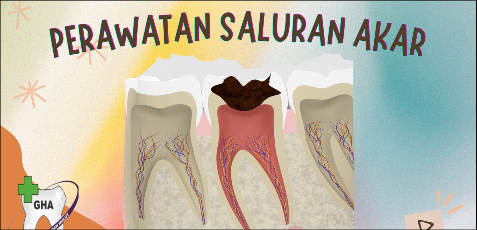 Perawatan Saluran Akar